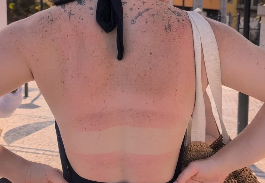 Girl's back being burned